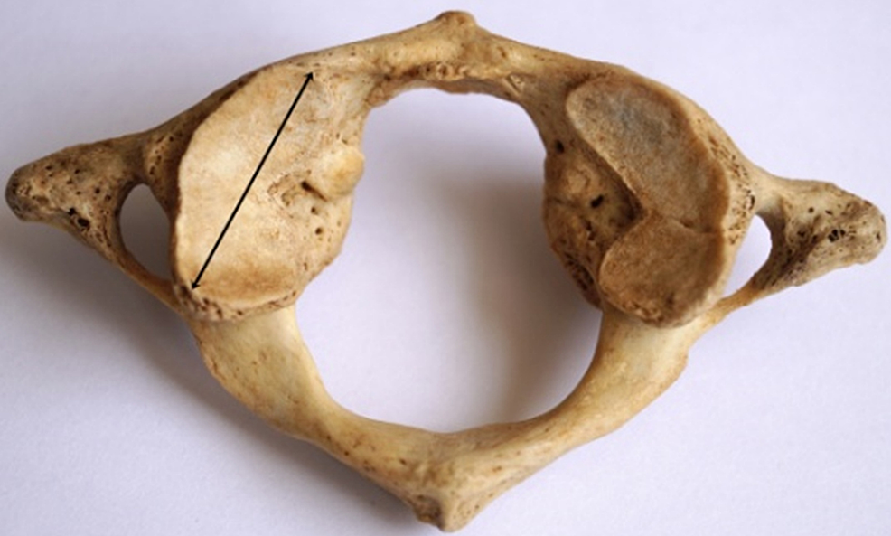 <p>Vetebrae that has no body; Superior articular processes large and form joint with occipital condyles; Primary movement = flexion and extension</p>