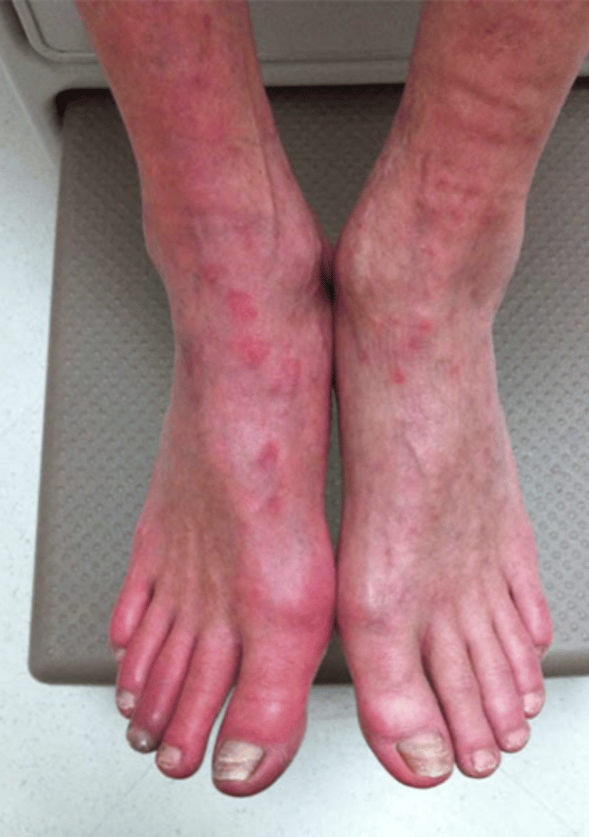 <p>Red skin</p>