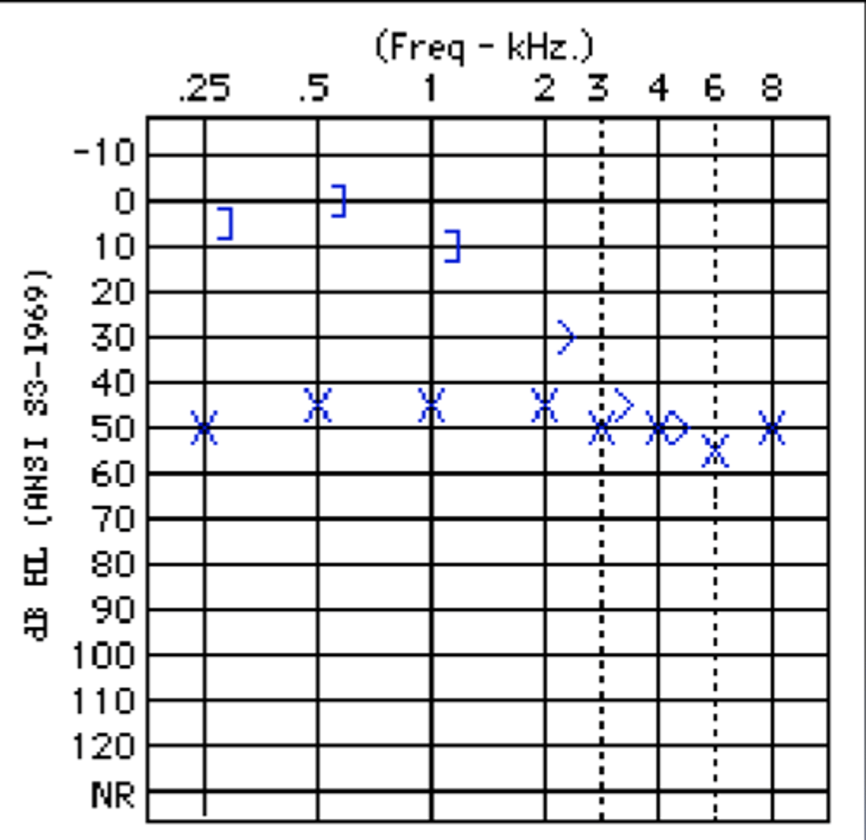 <p>- if both air conduction and bone conduction thresholds show hearing loss and the ABG &gt;10dB (greater than), there is a mixed hearing loss.</p>