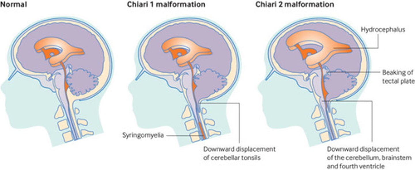<p>- type 1 -> normale positie 4 e ventrikel</p><p>- type 2 -> verlaging vierde ventrikel</p>