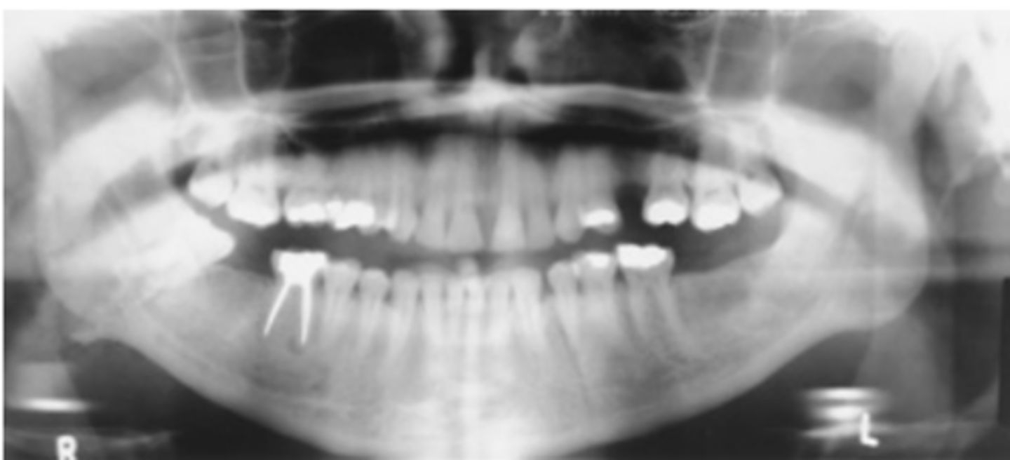 <p>-Position: The mandible visualized without rotation or tilting is indicated by the following: TMJs on the same horizontal plane in the image; rami and posterior teeth equally magnified on each side of the image; anterior and posterior teeth sharply visualized with uniform magnification</p>