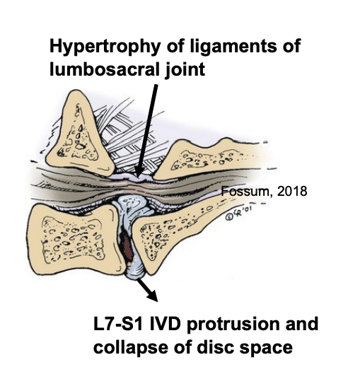 <p> = multifactorial: o Congenital vertebral malformation o L7-S1 intervertebral disc degeneration <span data-name="black_small_square" data-type="emoji">▪</span> Protrusion <span data-name="black_small_square" data-type="emoji">▪</span> Collapsed disc space o Hypertrophy of ligaments of lumbosacral joint (caused by instability) o Degenerative joint disease of articular processes o Spondylosis deformans • Collectively lead to narrowing of the vertebral canal and intervertebral foramen and nerve impingement</p>