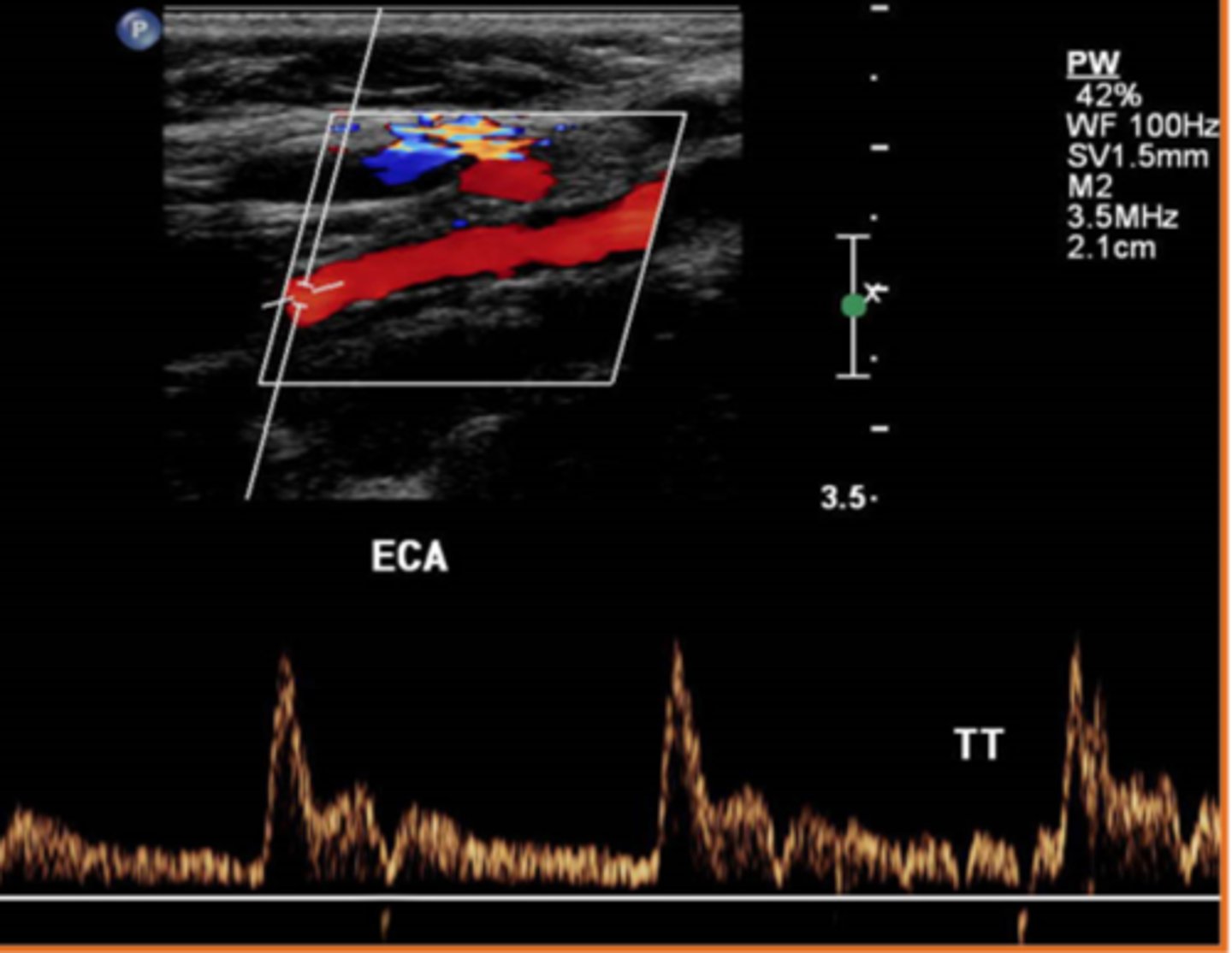 <p>the spectral Doppler tracing accelerates to a peak in systole and then touches the baseline during diastole</p>