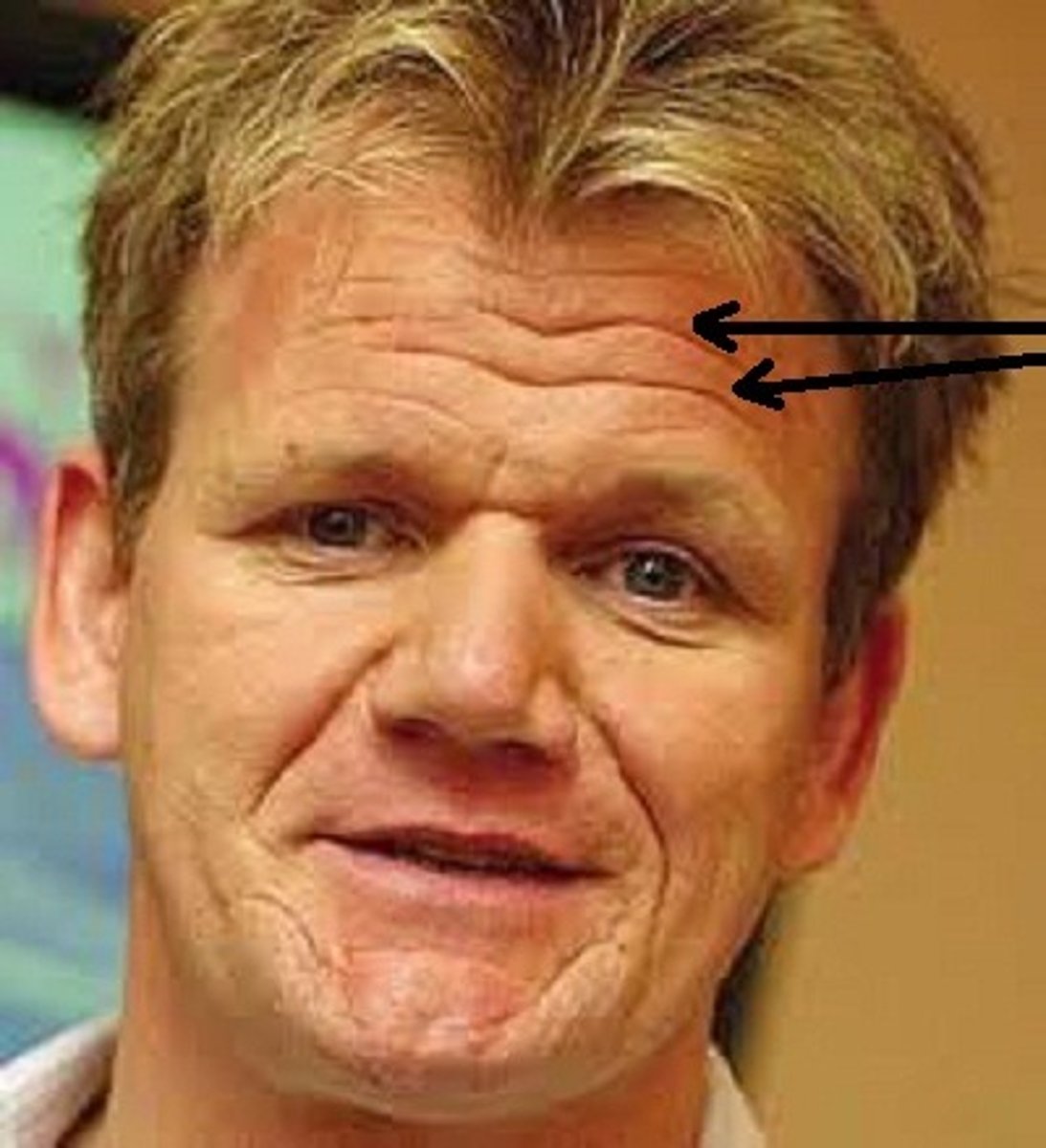 <p>transverse wrinkles on the forehead; acquired</p>
