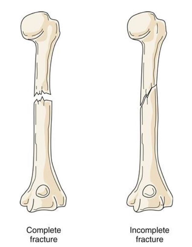 what are the degrees of fractures?