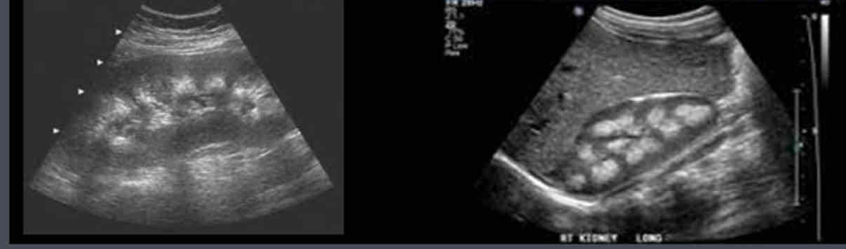 <p>What does the following describe?</p><p><span>• It’s an Autosomal recessive defect.</span><br><span>• Congenital dysplastic cystic dilatation of medullary pyramids due to tubular ectasia</span><br><span>or dysplasia</span><br><span>• Causes: urinary stasis, calcium deposits form in the dilated tubules</span></p>