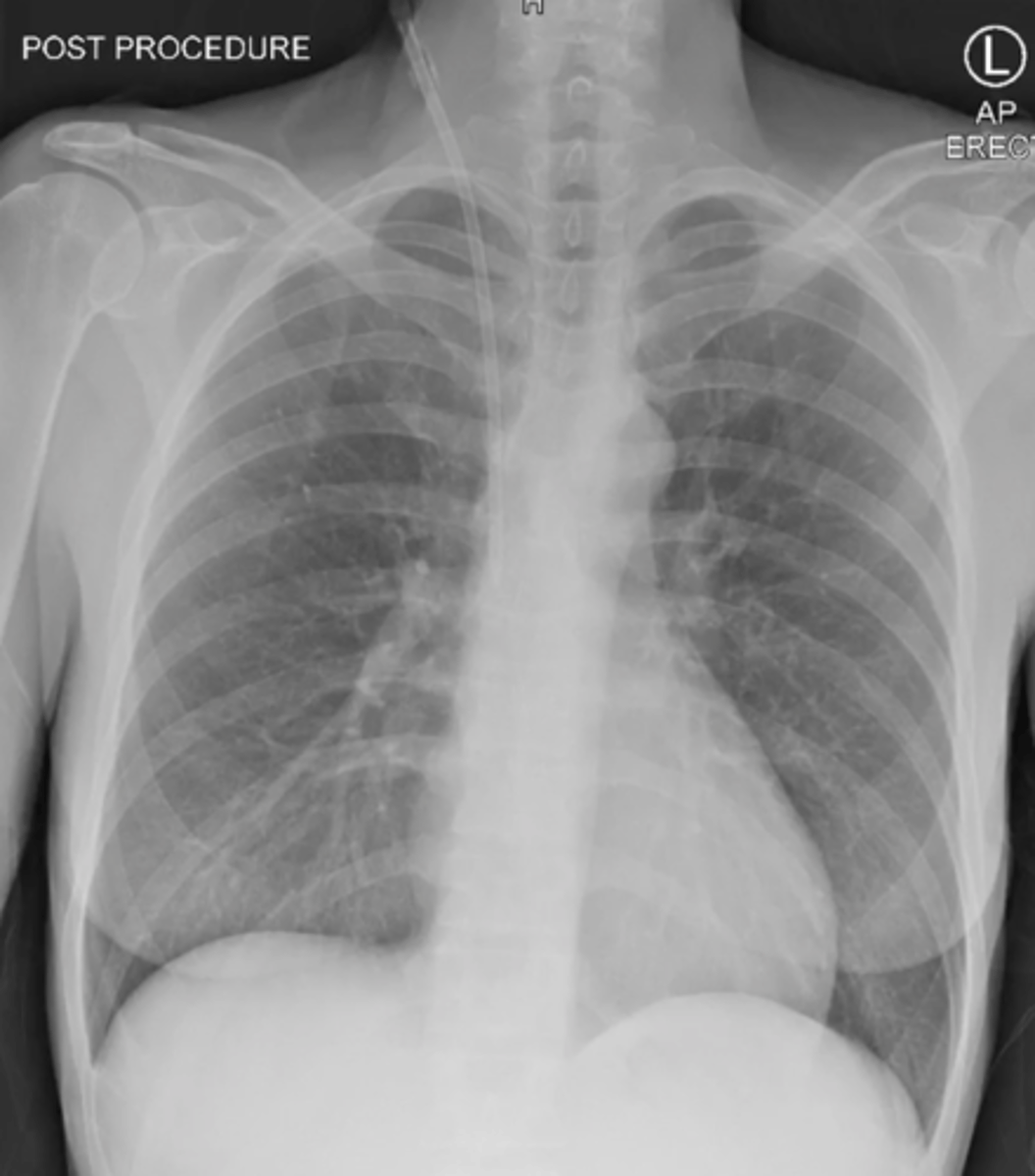 <p>tube that goes into internal jugular and goes into the right atrium</p>