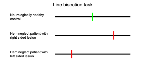 Evidence for Hemineglect: Line Bisection