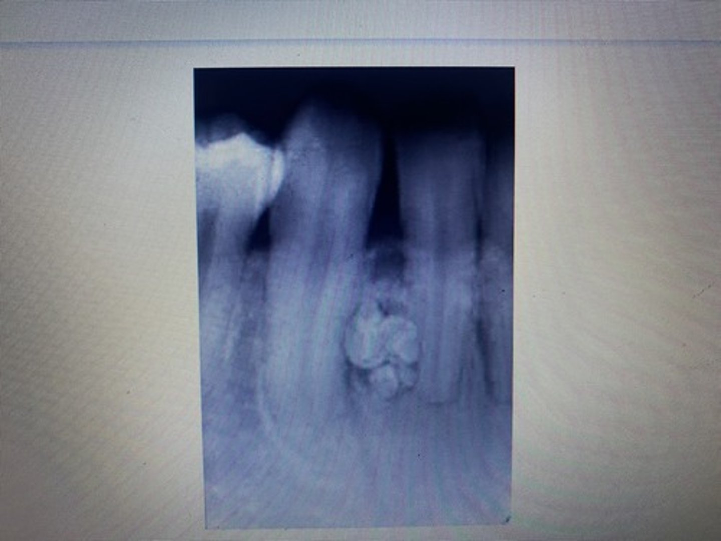 <p>Abnormal; Compound Odontoma (benign tumor, appears to be a cluster of small teeth)</p>