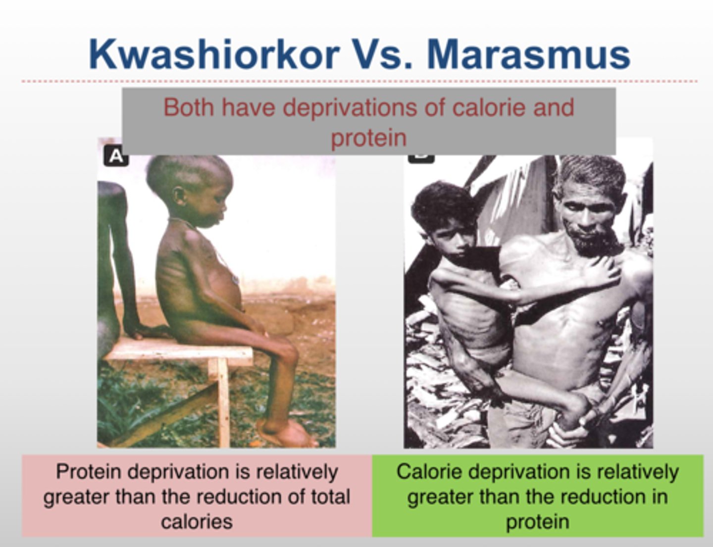 <p>A childhood disorder characterized by protein and energy malnutrition, resulting in dry skin, loss of adipose tissue from normal areas of fat deposits such as buttocks and thighs, and behavior that is fretful and irritable.</p>
