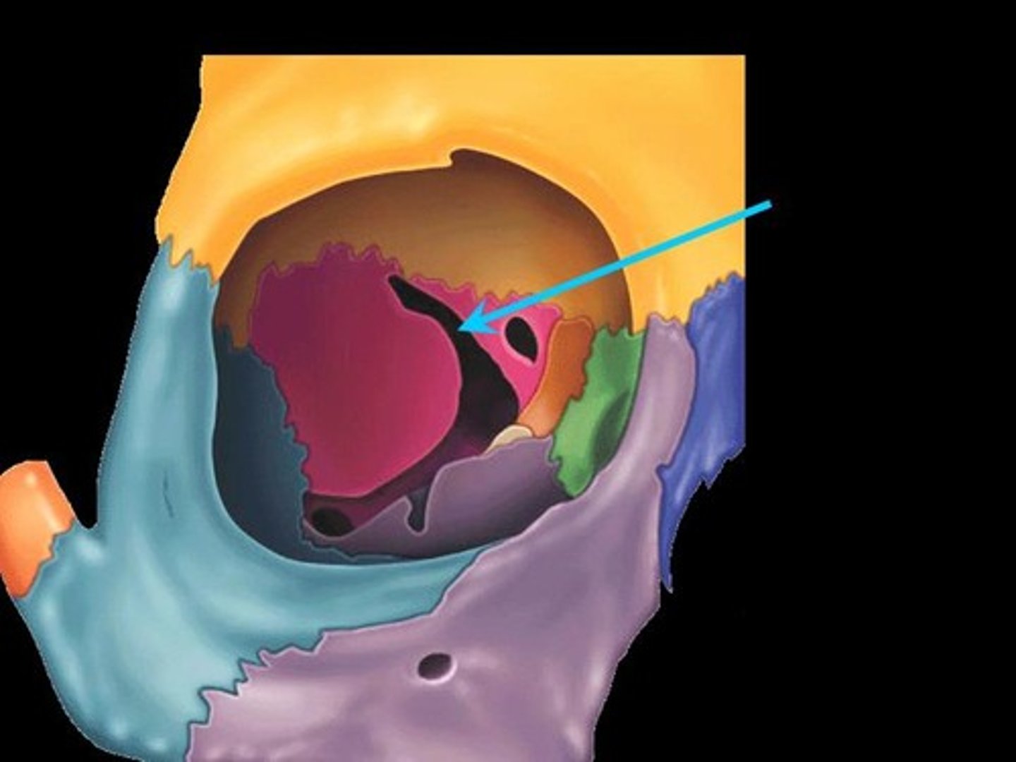 <p>Irregular elongated hole in a bone</p>