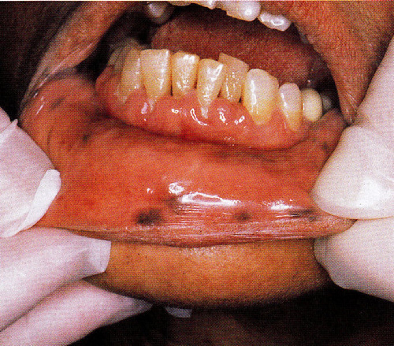<p>-multiple small to medium sized pigmented macules on the labial mucosa of a patient with peutz-jeghers syndrome</p><p>-also known as hereditary intestinal polyposis syndrome</p><p>-pigmentation occurs around the eyes, nose and mouth</p><p>-associated with gastrointestinal polyposis</p>