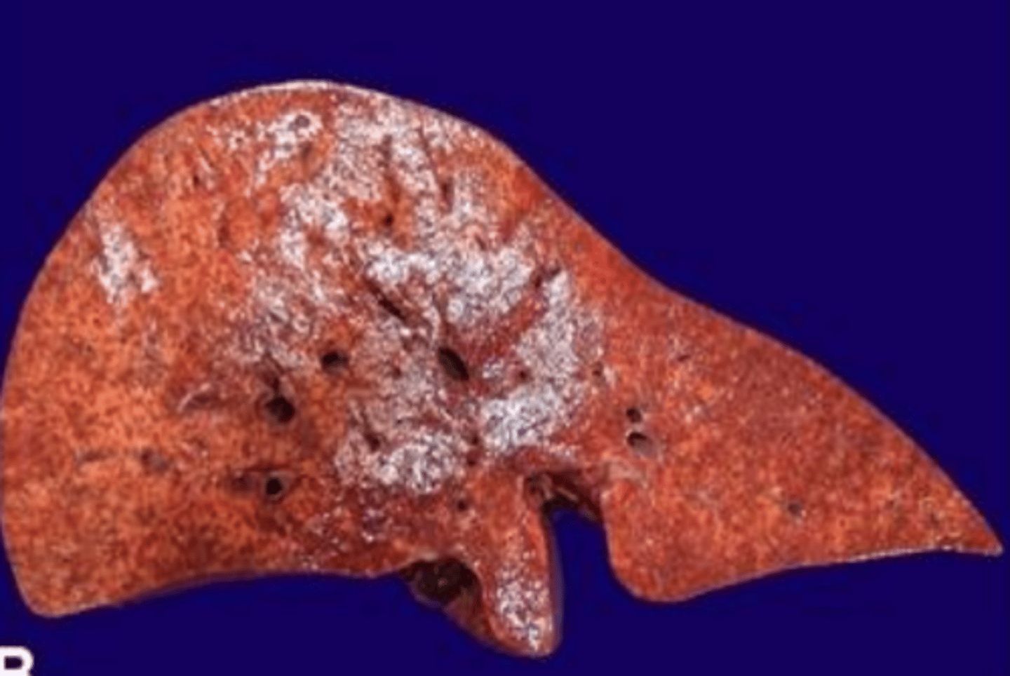 <p>what type of exudate is being depicted in the image?</p>