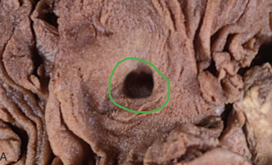 <p>results from necrosis caused by an acute inflammatory episode involving the mucosal lining or surface of an organ, followed by sloughing of the necrotic tissue and the formation of a crater</p>
