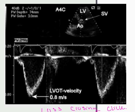 <p>Choose the most parallel</p><p>to flow (PTF)</p><p>Identify modal velocity</p><p>Decrease Doppler gains</p><p>and lower compression</p><p>Trace outer edge of modal</p><p>velocity to obtain the TVI</p>