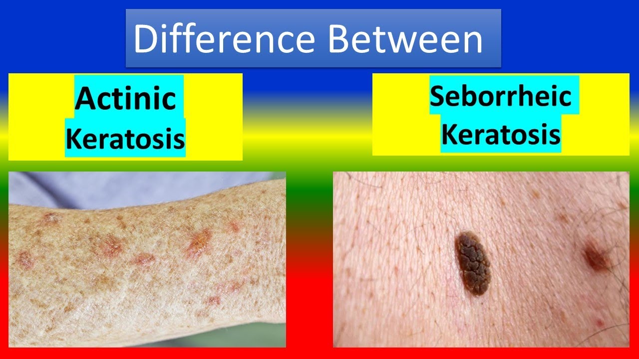 <p>What are the <u>classic clinical features</u> of<strong> Seborrheic Keratosis? (*5)</strong></p><ol><li><p><strong>Asymptomatic: </strong></p></li><li><p><strong>Color: </strong></p></li><li><p><strong>Size: </strong></p></li><li><p><strong>Texture: </strong></p></li><li><p><strong>Appearance:</strong></p></li></ol><p></p>
