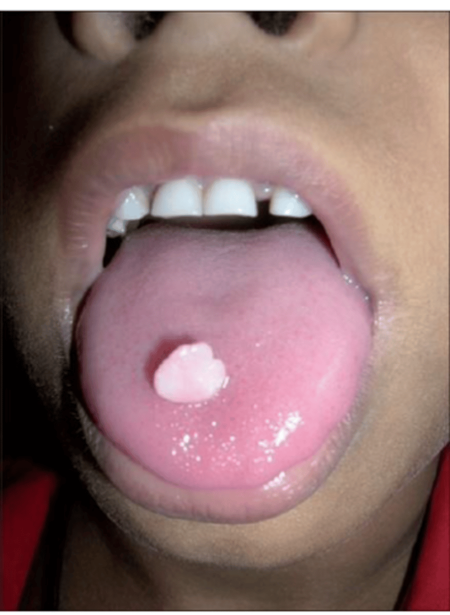 <p>• Asymptomatic</p><p>• The surface of the mass often</p><p>appears papillary</p><p>• More common in young patients</p><p>• Approximately 50% of all cases</p><p>occur on the gingiva</p><p>• Tongue and palate also are</p><p>common sites</p>