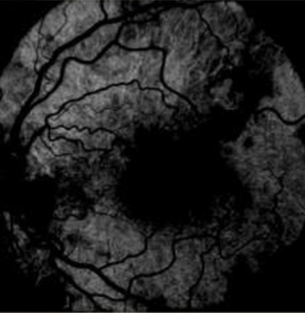 <p>patchy/lobular hyperF followed by overall hyperF glow of retina (due to fenestrated choriocapillaris that blood and NaFl moves freely through)</p>