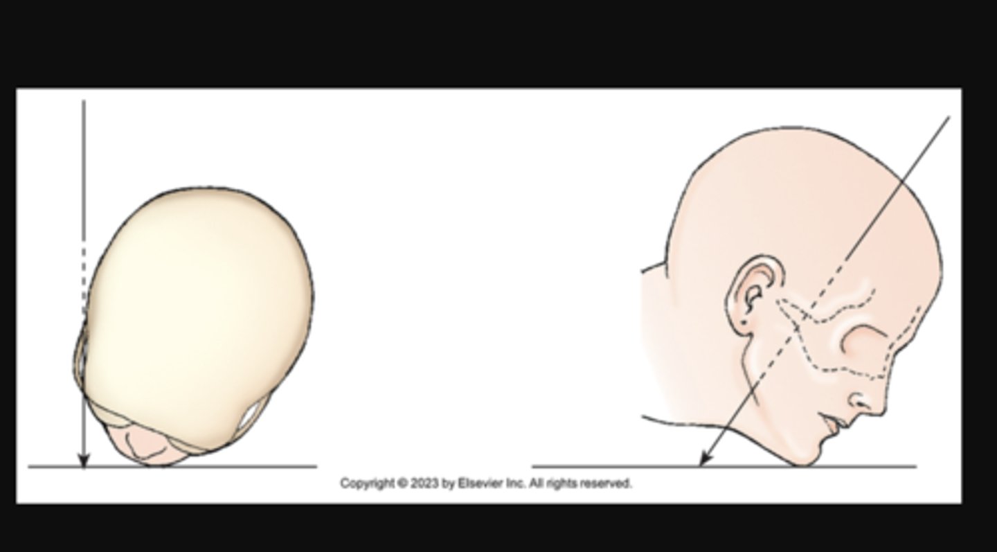 <p>central ray passes along side (or parallel to the long axis of the body or part SKIMMING)</p><p>CR directed along the outer margin of a curbed body surface</p><p>X projection of zygomatic arch. Central ray skims surface of the skull.</p>