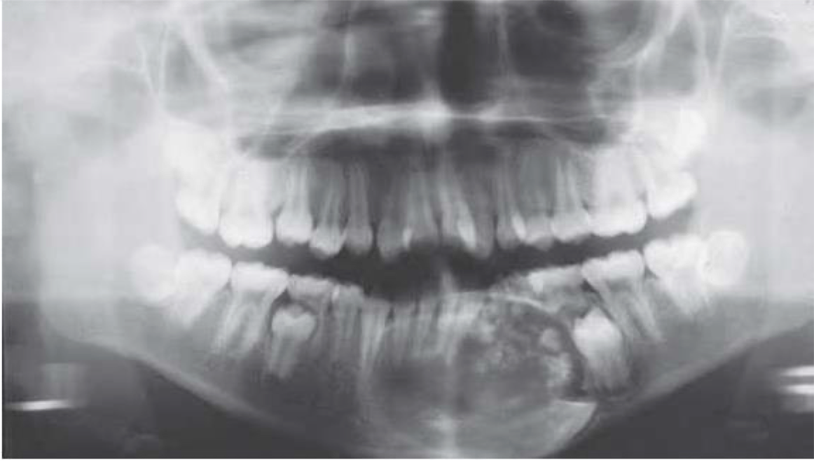 <p>A 30 year old female presented with complaint of swelling in the lower jaw. Intraorally a swelling was not over the left vestibule spanning over 43 to 35. Provide differential diagnosis.</p>