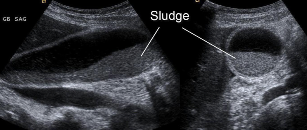 <ul><li><p>aka <em>thickened bile</em></p></li><li><p>results from bile stasis</p></li><li><p><u>gravity dependent</u>; slowly resettled upon LLD/LLO repositioning</p></li><li><p>can cause <mark data-color="yellow" style="background-color: yellow; color: inherit;">stone</mark> formation, <u>biliary colic</u> (abdominal pain), <u>acalculous cholecystitis</u>, and <u>pancreatitis</u></p></li><li><p>SONO: non-shadowing, low-level internal echoes (echogenic)</p></li></ul><p></p>