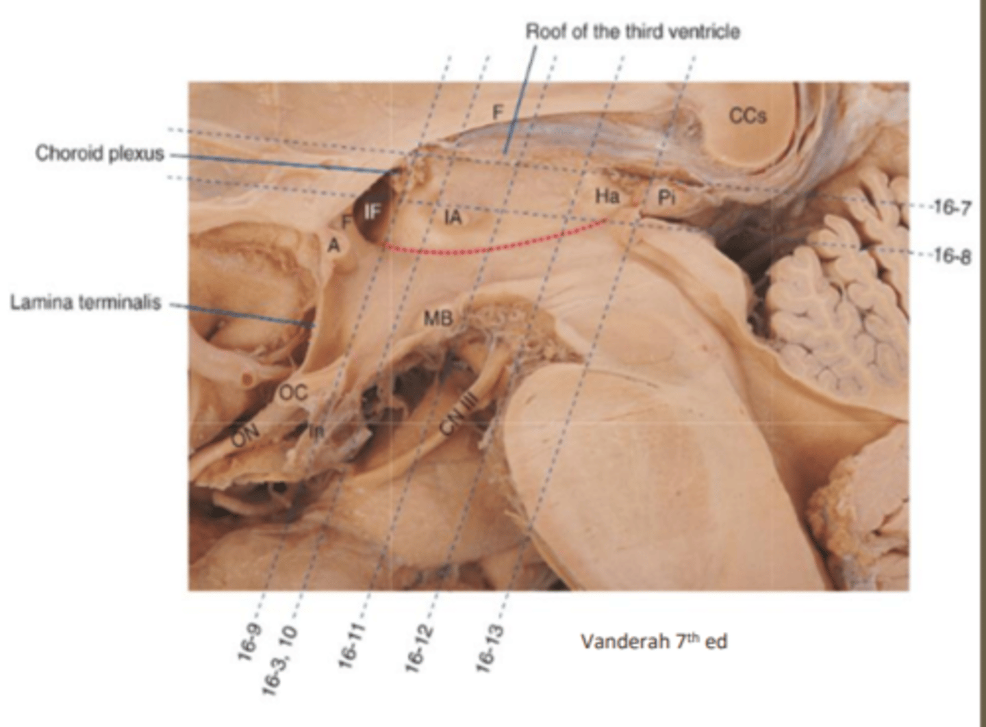<p>pineal tumors can result in compression of the midbrain, sexual dysfunction and abnormal regulation of circadian rhythm</p>