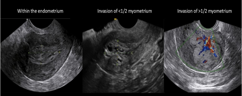 <p>in<strong> stage 1</strong> endometrial cancer, the cancer has invaded the</p><p>a) pelvic lymph nodes</p><p>b) ovaries</p><p>c) myometrium in body of uterus</p><p>d) cervix</p>