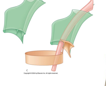 <p>What artery?</p>