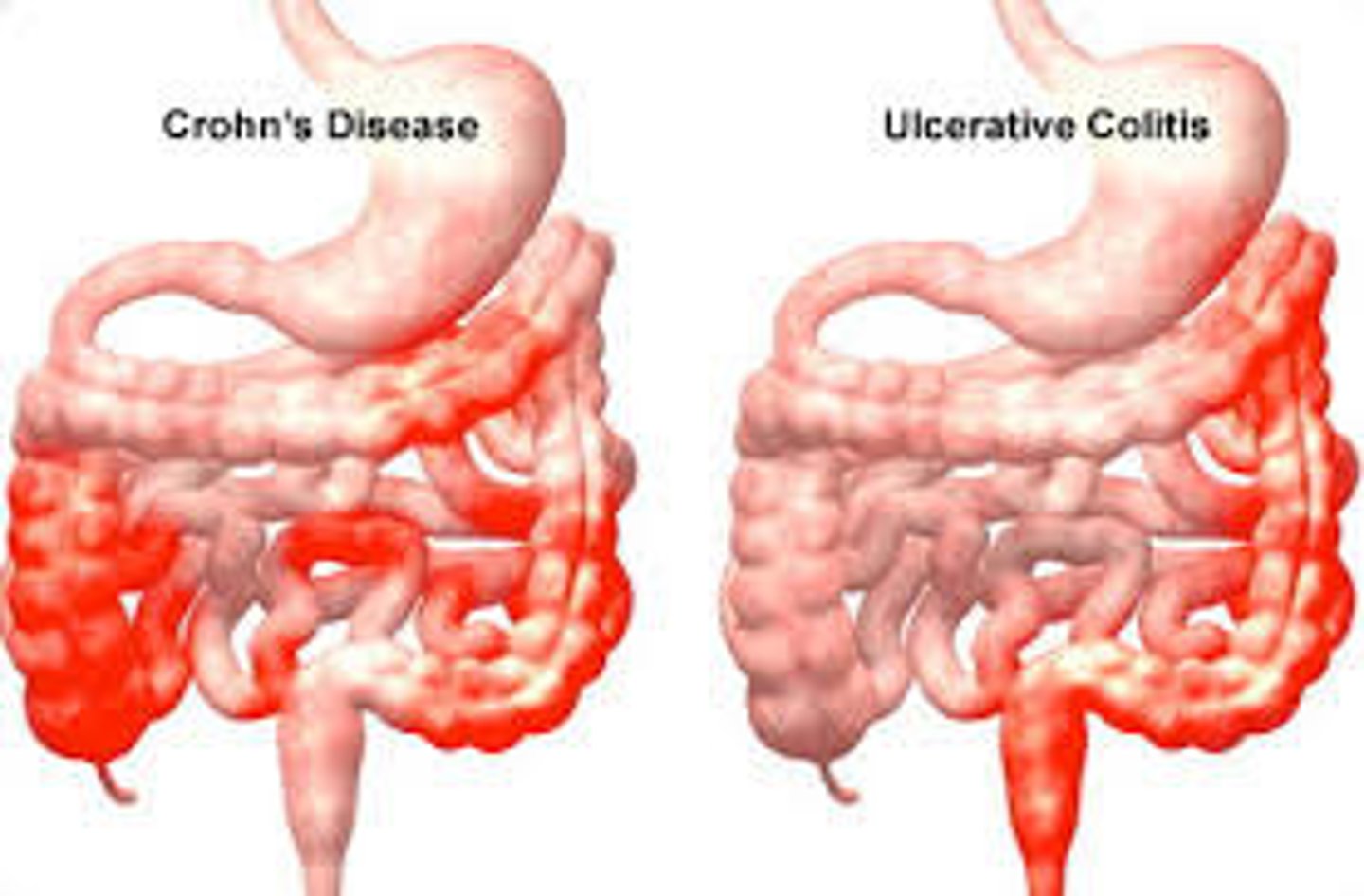 <p>- IBD</p><p>- hemorrhoids</p>