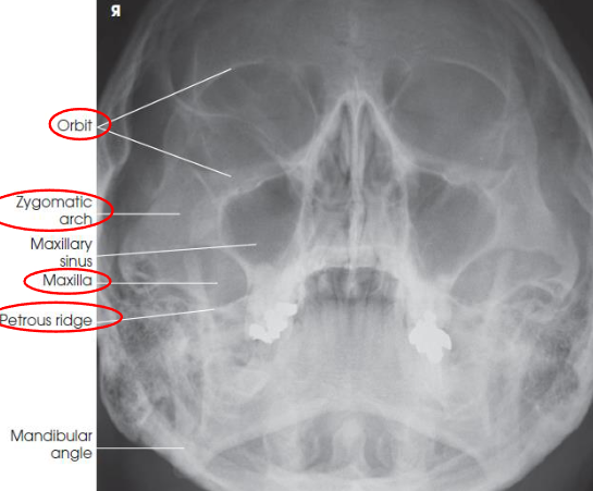 <ul><li><p>shows orbits, maxillae, and zygomatic arches</p></li><li><p>entire orbits and facial bones</p></li><li><p>no rotation or tilt:</p><ul><li><p>distances between the lateral borders of the skull and the orbits</p></li><li><p>MSP of head aligned with long axis of collimated field</p></li></ul></li><li><p>petrous ridges projected just below maxillary sinuses</p></li></ul><p></p>