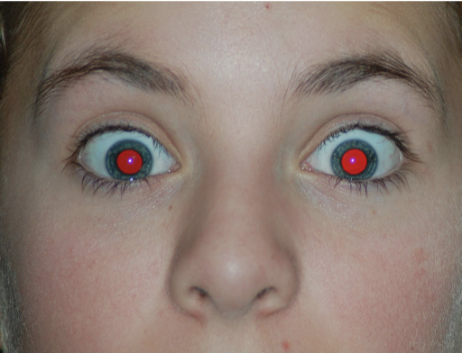 <p>the “red eye” effect is due to what?</p>