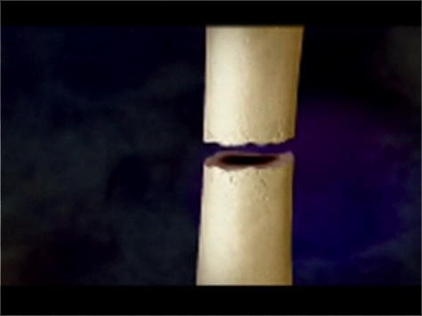 <p>Bone is broken completely through</p>