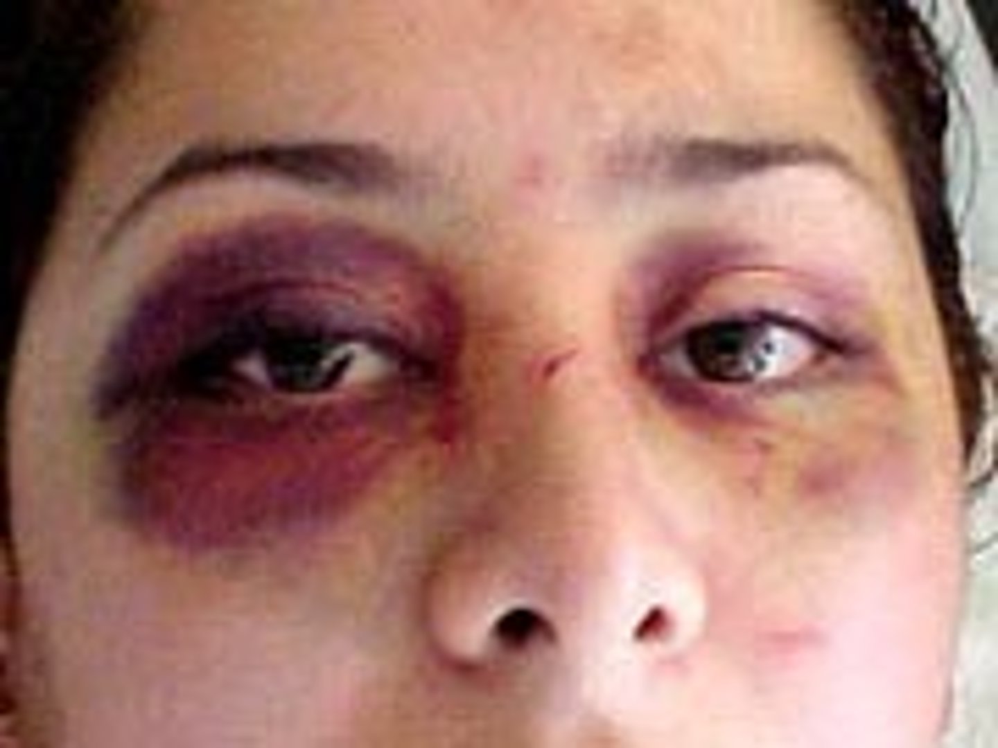 <p>Bruising around the eyes, indicative of a basilar skull fracture</p>