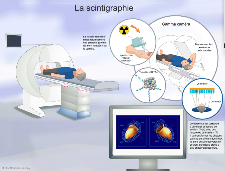 <p>On administre une molécule vectrice à laquelle on a associé par chimie de coordination du technétium 99 métastable. Le patient devient radioactif. Le médicament va se distribuer dans les organes qui sont en lien avec la structure vectrice utilisée. On détecte ensuite les rayonnements qui sortent du patient </p>