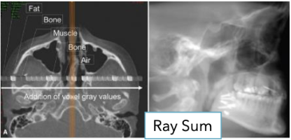 <ul><li><p><span style="color: #000000">Image slab created by increasing number of adjacent voxels included in display </span></p></li><li><p><span style="color: #000000">Gives appearance of anatomic superimposition (2D)</span><span style="color: #000000"><br></span><span style="color: #000000">without magnification or distortion</span></p></li></ul><p></p>
