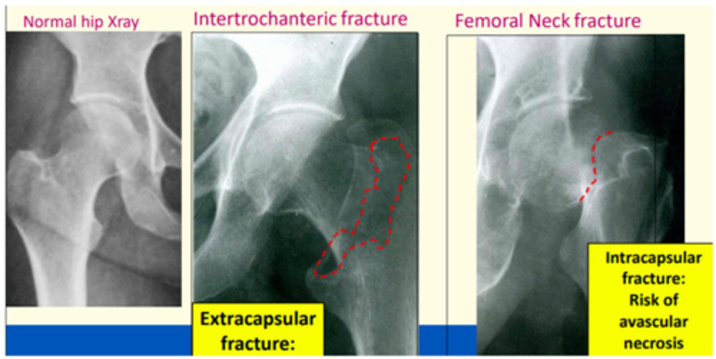 <p>Intracapsular</p><p>Extracapsular</p>