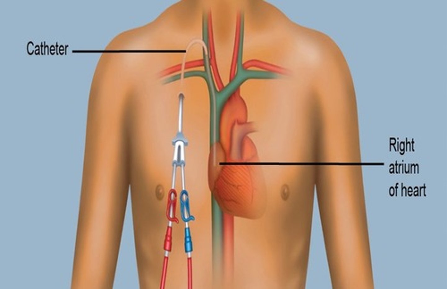 <p>A _________ is a thin, flexible tube that is inserted into a vein, usually below the right collarbone, and guided (threaded) into a large vein above the right side of the heart.</p>