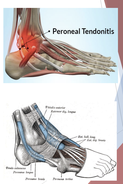 <p>Tendinopathy</p>