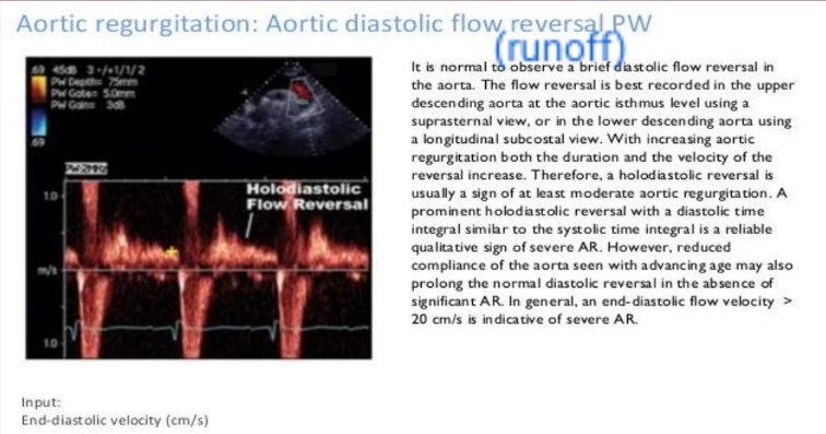 <p>Determining its severity by assessing the descending AO and the Abdominal AO to see how far back the leaking is coming from. Absences of reversed blood flow means it is probably less severe AR. Presence of reversed blood flow means that it is more severe.</p>