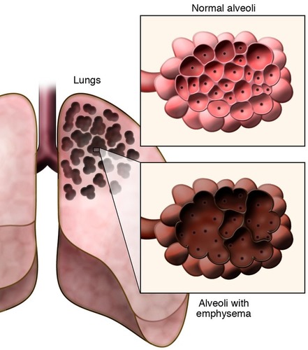 Emphysema is a lung disease caused by the weakening and rupturing of alveoli. As a result there are larger air spaces instead of many small ones.  Having fewer and larger damaged sacs means there is a reduced surface area for the exchange of oxygen into the blood and carbon dioxide out of it. 

Smoking is the leading cause of emphysema.