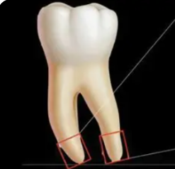 <p>A tiny hole at the tip of the tooth root where nerves and blood enter.</p>