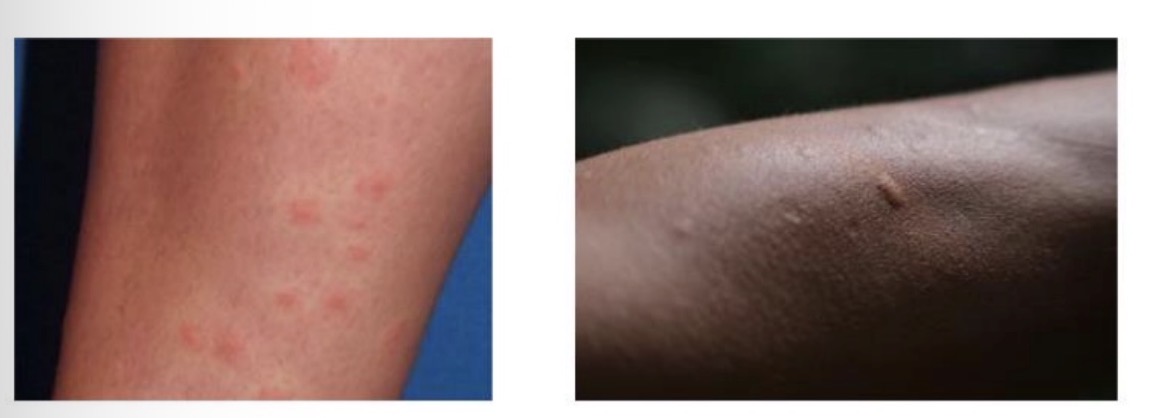 <ul><li><p>Rapid onset, inflammatory reaction - erythema, tenderness, swelling, itchy papules</p></li><li><p>Can cause allergic reaction or become infected</p></li><li><p>Allergic reaction occurs within 24 hours, infection usually develops after 24-48 hours: pus, warm to touch, fever</p></li><li><p>Complications: urticaria, anaphylaxis, malaria</p></li><li><p>Tend to overtreat</p></li></ul><p></p>