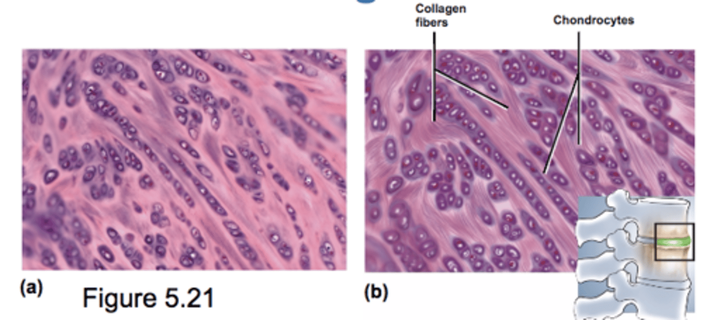 <p>large, coarse bundles of parallel collagen fibers</p><p>resists compression and absorbs shock</p><p>found in symphyses (intervertebral and pubic) and menisci in knee</p>