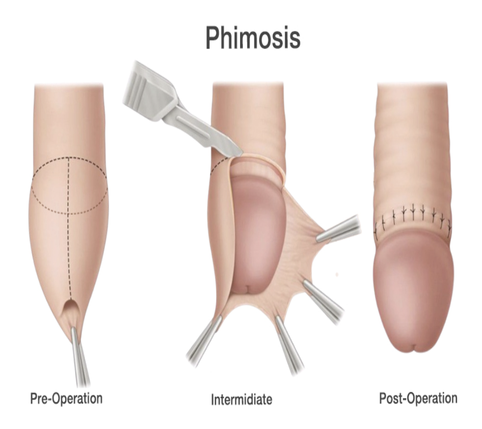 <p>inability to protrude the penis </p>