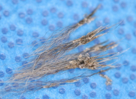 <ul><li><p><span style="color: rgb(136, 136, 136);"><strong>Et: </strong></span><strong>inflam disorder of sebaceous gland</strong>s → destruction</p></li><li><p><span style="color: rgb(136, 136, 136);"><strong>Sig:<u> plush coated dogs:</u></strong></span> Poodle, Akita, Vizsla, Samoyed, Chow, young adult to middle-aged</p></li><li><p><span style="color: rgb(136, 136, 136);"><strong>Cs:</strong></span><strong> scaling, follicular casts, dry broken hairs (brown/red)</strong>, nodular alopecia, fine white scaling,<strong> “Moth-eaten” alopecia</strong></p><ul><li><p><strong>Bilateral symmetric</strong>, head, ears, <u>dorsal trunk</u>, tail, legs</p><ul><li><p><u>Secondary pyoderma with resulting pruritus</u></p></li></ul><img src="https://knowt-user-attachments.s3.amazonaws.com/8a012098-1e64-4168-8420-5670a935a6ef.png" data-width="25%" data-align="center"></li></ul></li></ul><ul><li><p><span style="color: rgb(136, 136, 136);"><strong>Dt:</strong></span><strong> </strong>Histopath</p><ul><li><p>acanthosis, hyperkeratosis, follicular plugging, keratin sheathing hairs, <strong><u>absent sebaceous glands</u></strong>, granulomatous&nbsp; perifollicular inflam</p></li></ul><img src="https://knowt-user-attachments.s3.amazonaws.com/e21dbec3-4d53-45df-928f-47a0a386cad9.png" data-width="50%" data-align="center"></li><li><p><span style="color: rgb(136, 136, 136);"><strong>Tx:</strong></span> Spontaneous, keratolytic shampoos, <strong>emollient/oil/ propylene glycol rinses,</strong> FA supplements, synthetic retinoids, <strong>cyclosporine</strong>, tetracycline, niacinamide</p></li></ul><p></p>