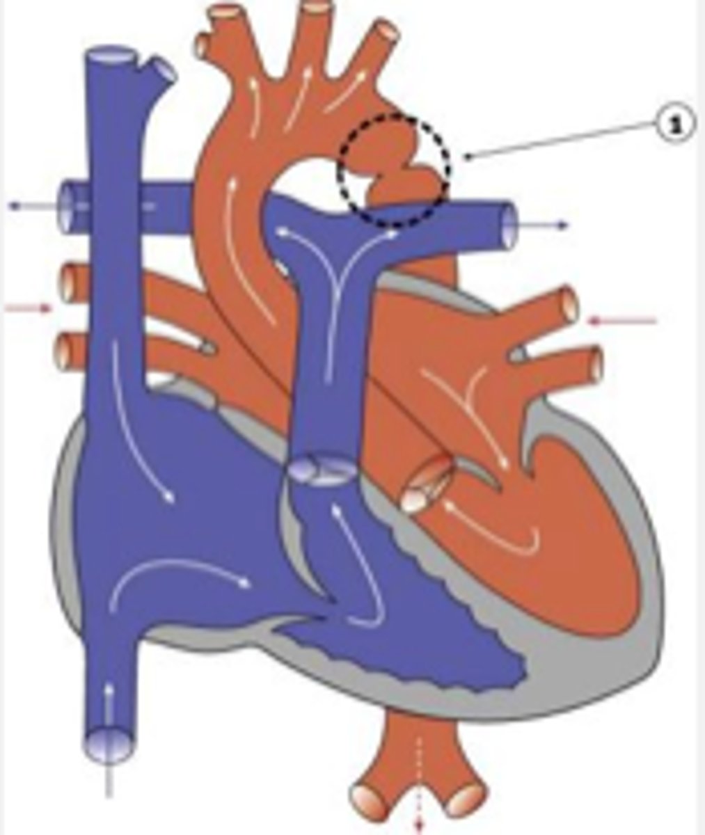 <p>narrowing of the aorta, resulting in reduced blood flow from the ventricles</p>