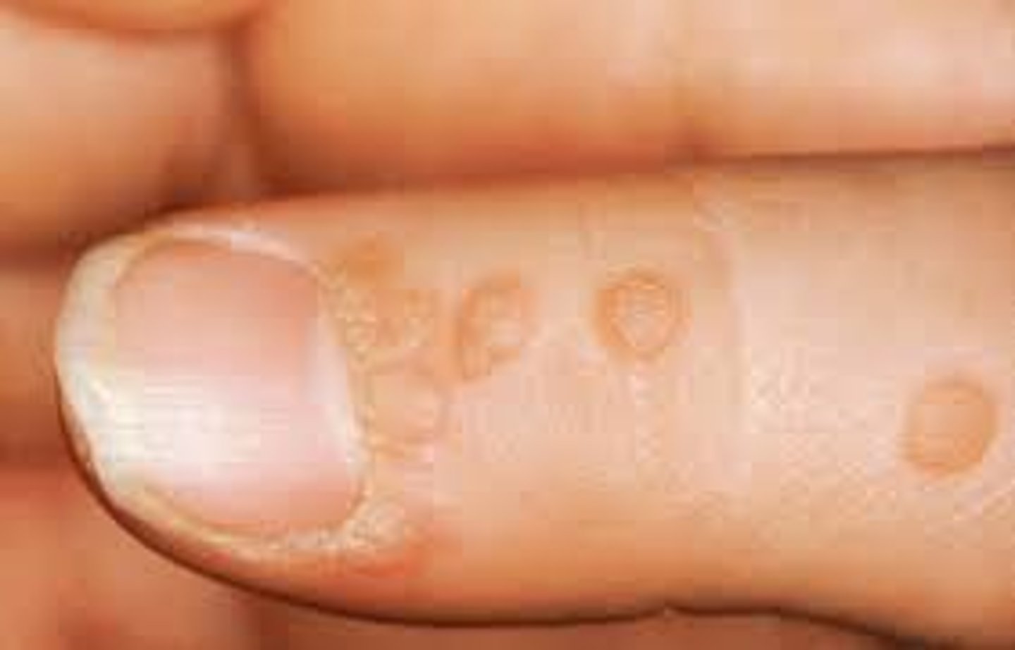 <p>warts that typically appear on the hands or fingers and disappear without treatment</p>