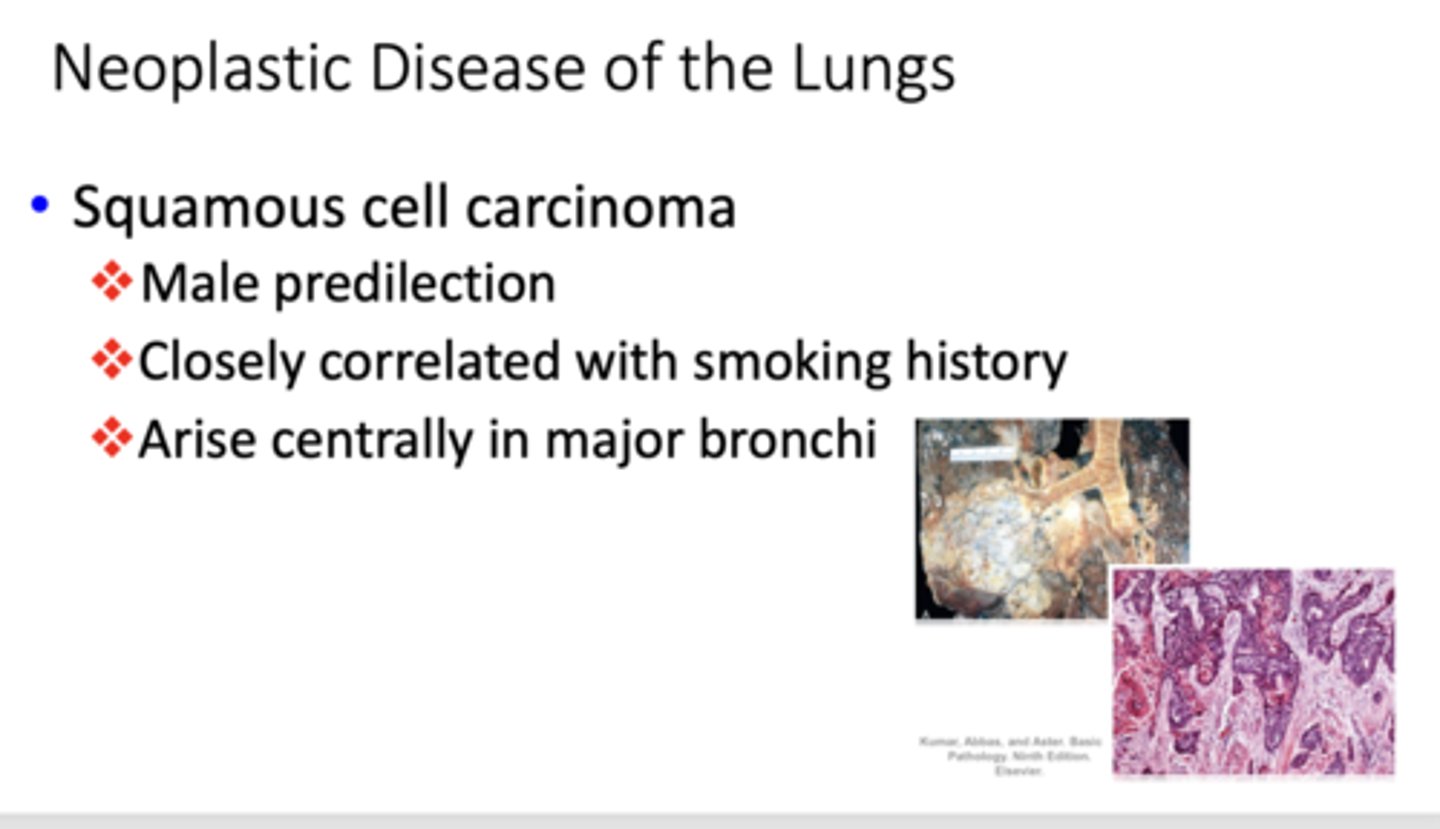 <p>squamous cell carcinoma</p>