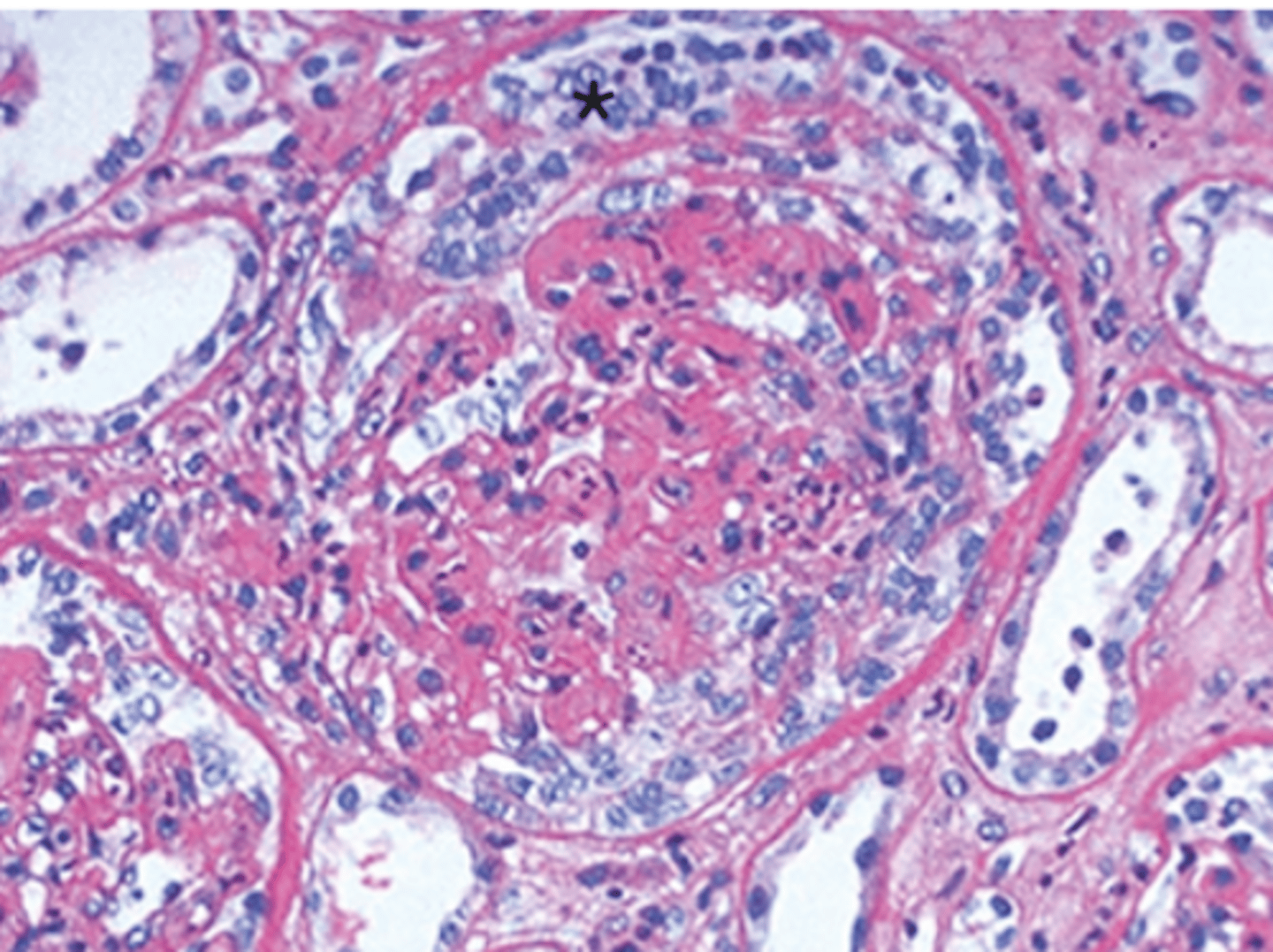 <p>-crescentic glomerulonephritis</p><p>-crescents composed of visceral epithelial cells (podocytes) cause by severe glomerular damage--> fibronogen to leak into bowman's space--> proliferation of podocytes</p><p>-diffuse linear IgG complex in glomeruli</p><p>-hemorrhagic lung</p>