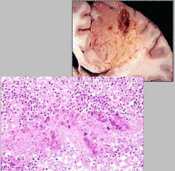 <p>What is this type of necrosis? What is the cause? Describe the gross and histological appearance.</p>